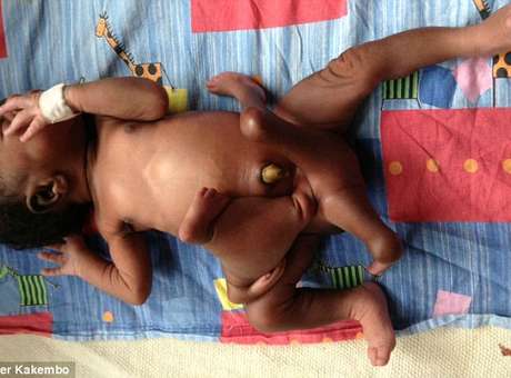 Menino nasceu com quatro pernas e quatro braços em cidade de Uganda