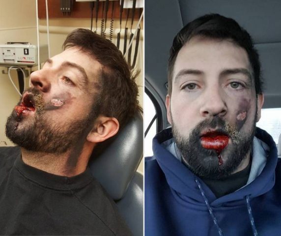 Homem perde dentes e sofre queimadura em explosão de cigarro eletrônico