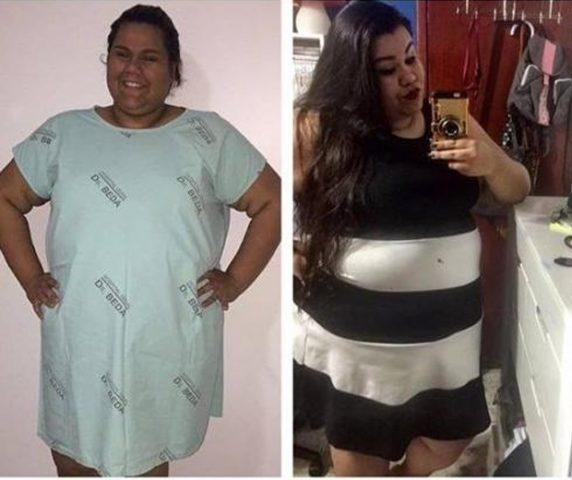 Após anos sofrendo bullying, jovem obesa de 19 anos decide operar e morre