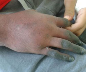 Jovem tem braço amputado após aplicação de injeção em hospital: "Eles vão ter que pagar"