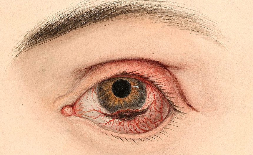 Estudo revela que novo método de terapia fotodinâmica pode eliminar o melanoma ocular