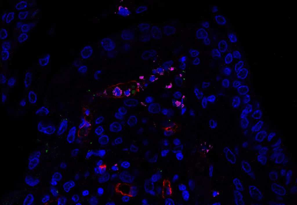 Forma grave da COVID-19: Inflamação pulmonar e alta replicação viral como principais perfis