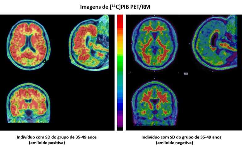 Estudo da doença de Alzheimer em indivíduos com síndrome de Down utilizando técnica de medicina nuclear