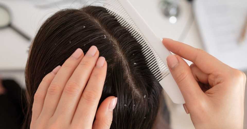 Dicas de tratamento para quem sofre com caspa no cabelo