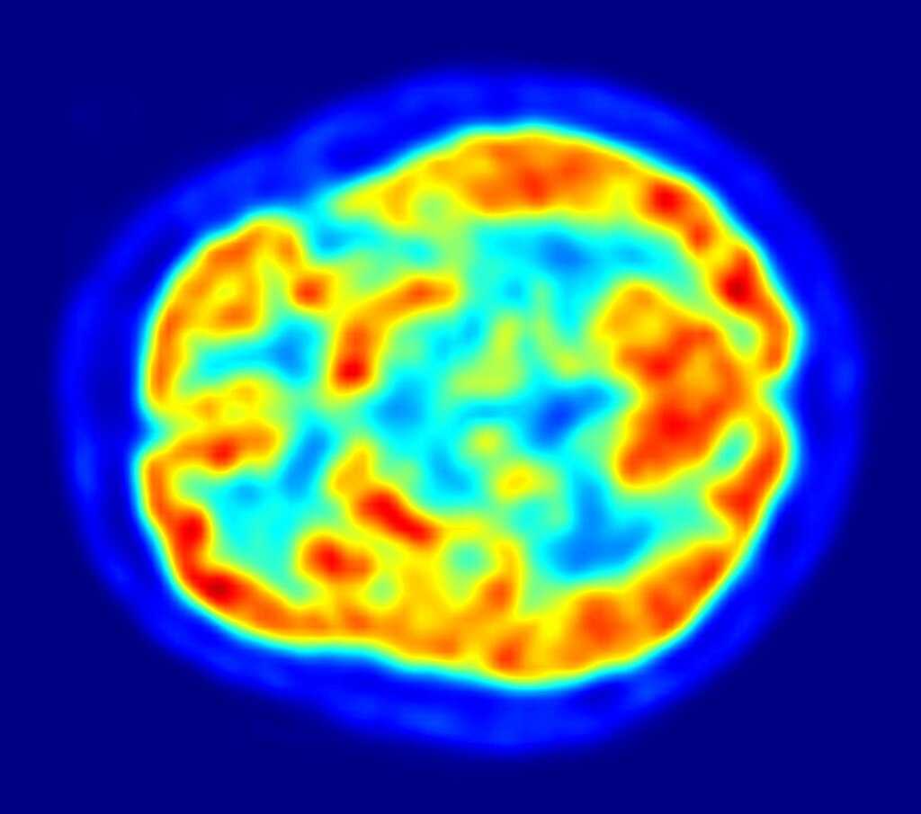 Identificação de marcadores para os cinco estágios da doença de Parkinson em estudo global