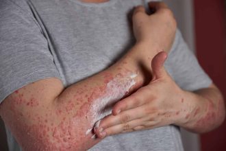 Herpes-zoster: o que é e como ele se relaciona com a catapora?