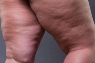 Por que o lipedema é mais comum em mulheres?