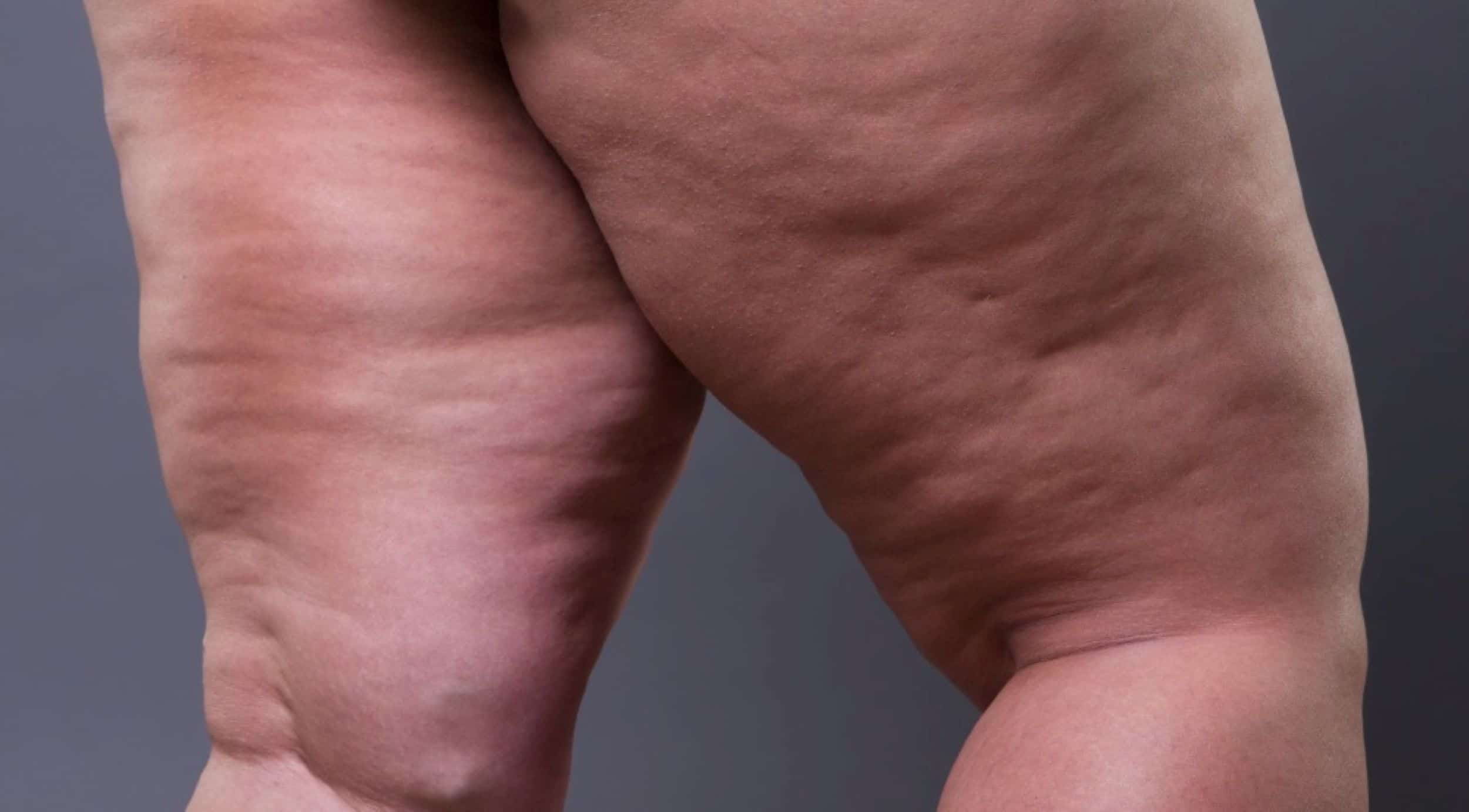 Por que o lipedema é mais comum em mulheres?