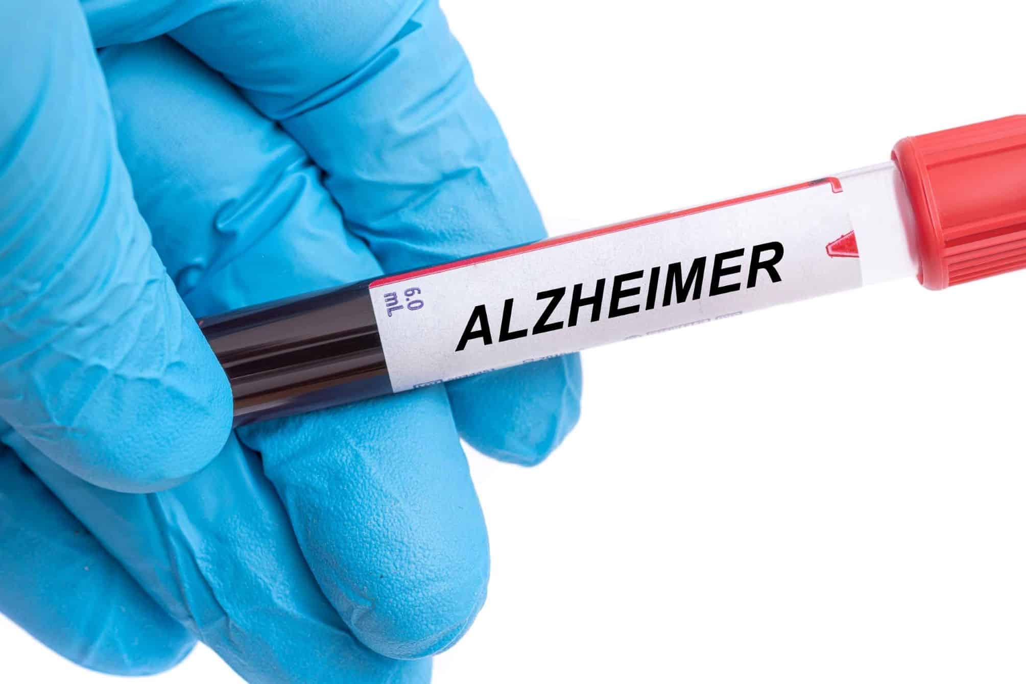 Alzheimer pode ser causado por infecção nas gengivas, diz estudo